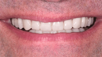 Aviva website - B&A - crowns, veneers and implants