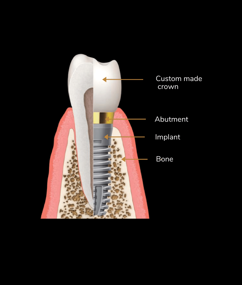 Aviva website - What is a Dental Implant_ (1)