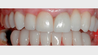 _Aviva website - crowns, veneers & bridges - after - smile gallery