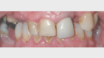 _Aviva website - crowns, veneers & bridges - before - smile gallery