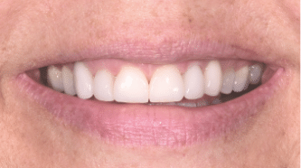 B&A - Cerec veneers - after