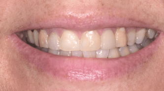 B&A - Cerec veneers - before