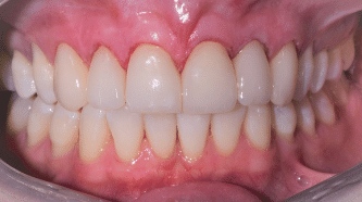 B&A - crowns, veneers and implants - after