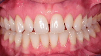 B&A - crowns, veneers and implants - before