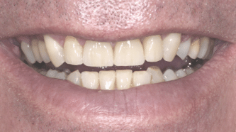 B&A - implants, crowns and veneers - after