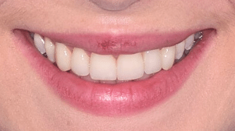 Before & After - 6 Veneers - after