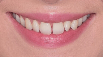 Before & After - 6 Veneers - before