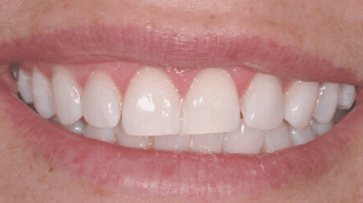 Whitening - after