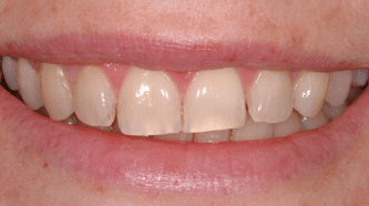 Whitening - before