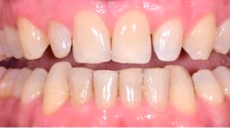 Aviva website - B&A - veneers male spacing in a day - before