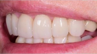 Aviva website - B&A - veneers to treat excessive gums - after