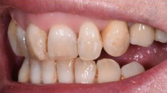 Aviva website - B&A - veneers to treat excessive gums - before