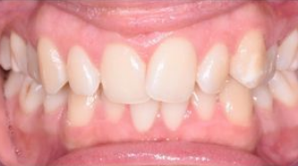 Aviva website - Invisalign - 1 - crowded smile - before