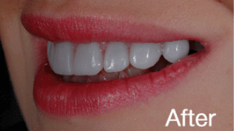 Cerec BA 1 - after (1)