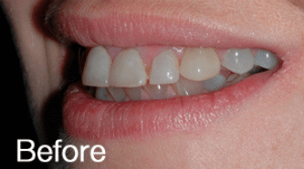 Cerec BA 1 - before (1)