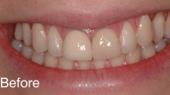 Cerec BA 11 - before (1)