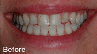 Cerec BA 2 - before (1)