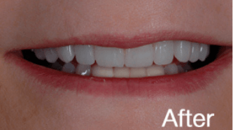 Cerec BA 3 - after (1) (1)