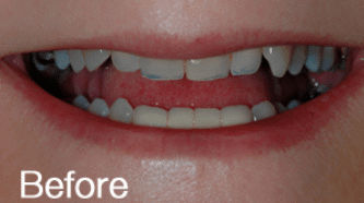 Cerec BA 3 - before (1) (1)