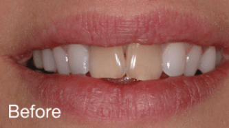 Cerec BA 5 - before (1)