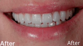 Aviva Cerec 2 afters (1)