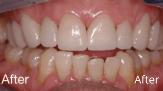 Aviva Cerec afters (1)