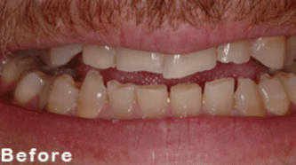 Copy of Aviva Cerec 7 afters (1)